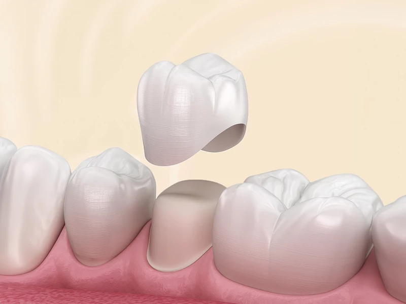 Bọc răng sứ thẩm mỹ