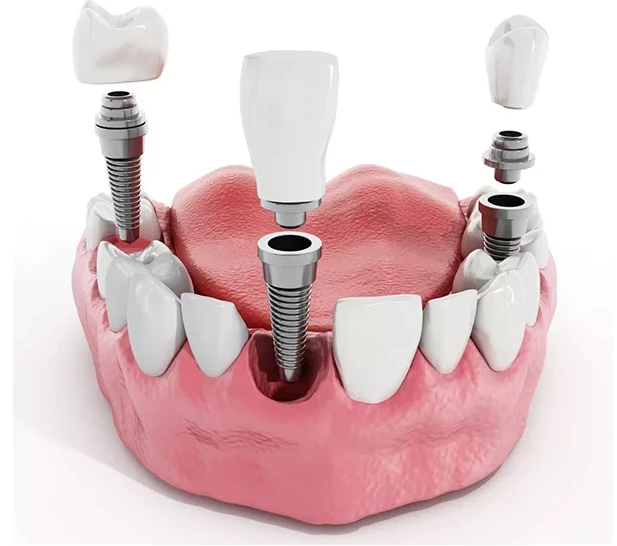 Cấy ghép Implant