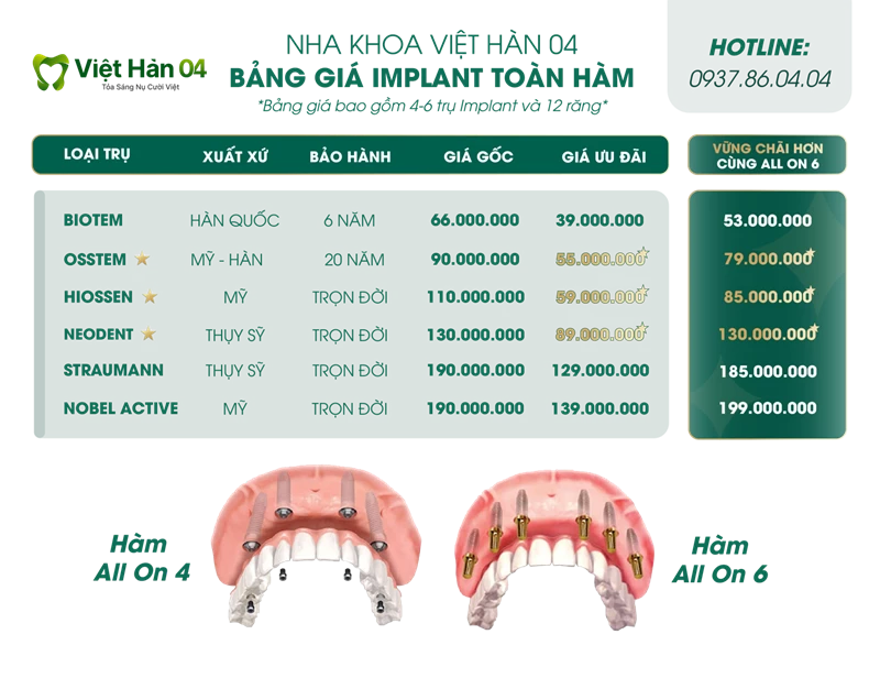 Bảng giá trồng răng implant toàn hàm