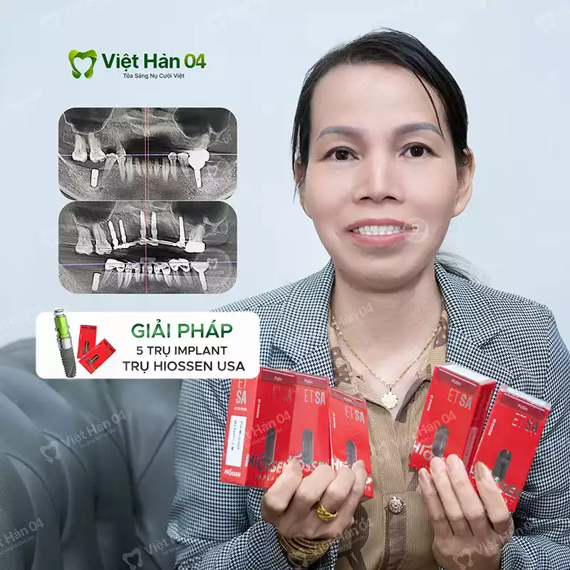 Trồng 5 trụ Implant Hiossen USA