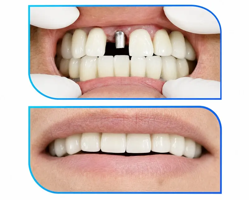 Cấy ghép Implant răng cửa hàm trên bền chắc như răng thật 