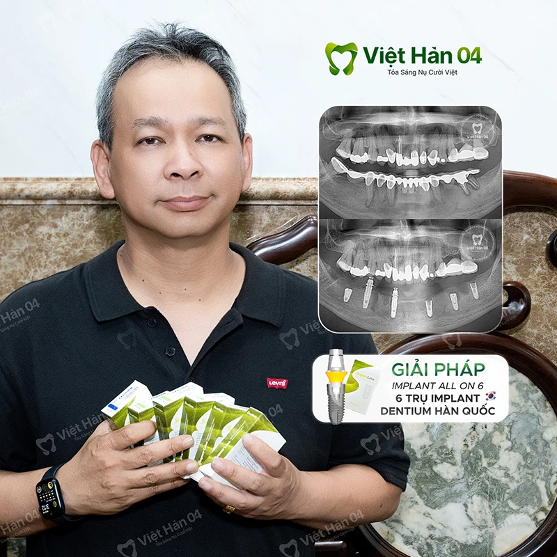 Trồng răng Implant All On 6 trụ Dentium Hàn Quốc