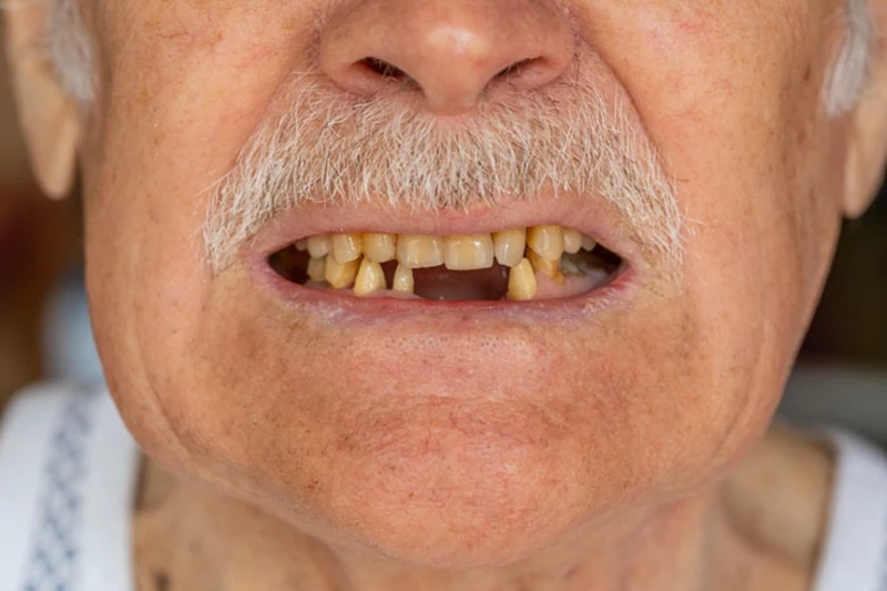 Trồng răng implant cần thiết với những người bị mất răng 