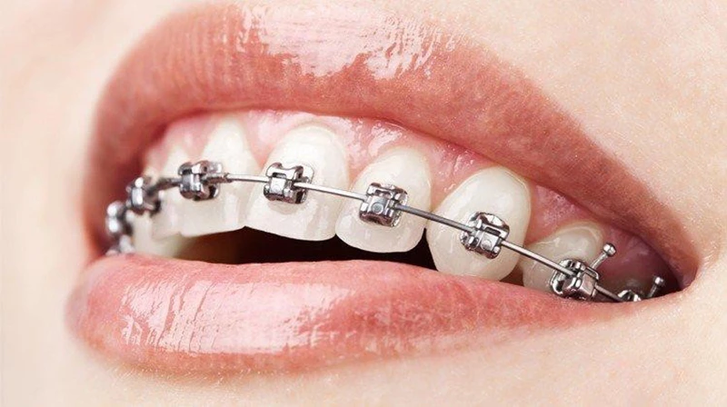 Niềng răng thẩm mỹ