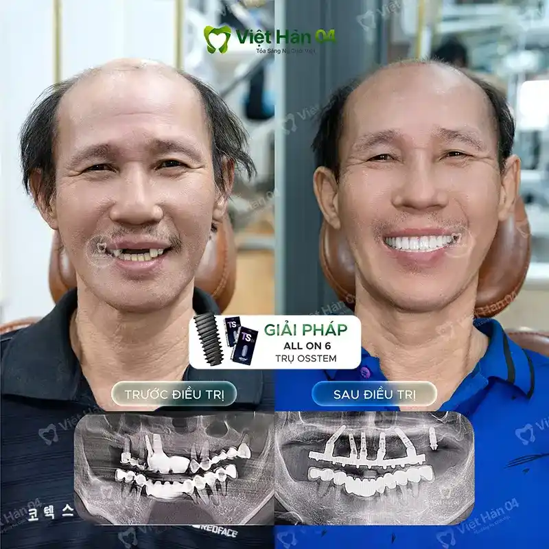 Khách hàng Văn Quát cấy ghép Implant toàn hàm all on 6 - Nha Khoa Việt Hàn 04