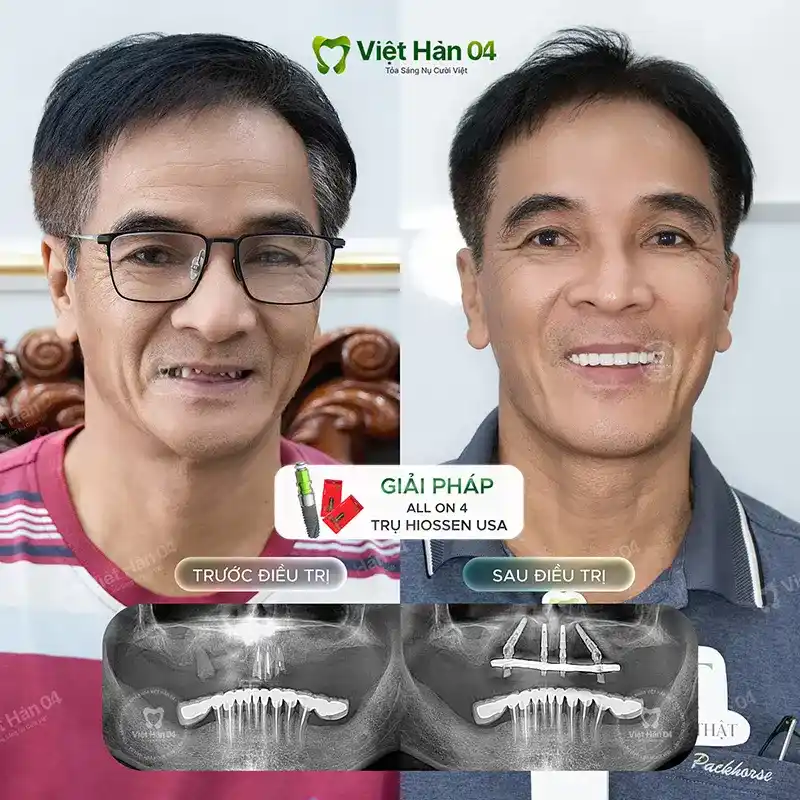 Khách hàng Đình Thọ (Vũng Tàu) cắm Implant toàn hàm all on 4 Hiossen USA - Nha Khoa Việt Hàn 04