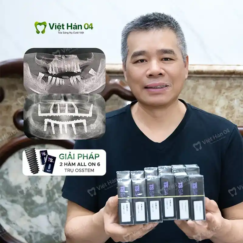 KH Tú Nguyễn - Việt kiều Canada - Cấy ghép Implant Toàn Hàm