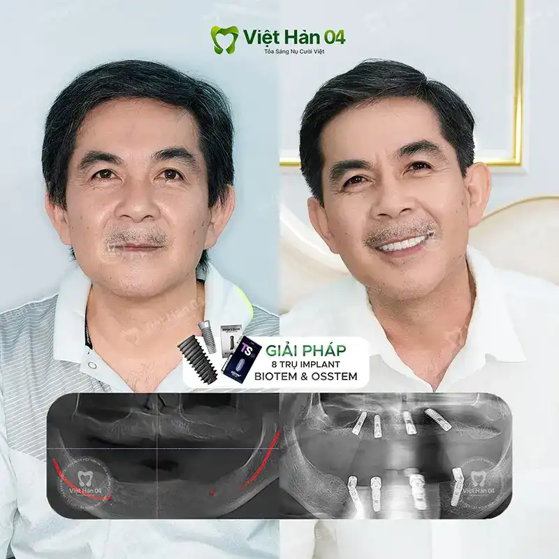 Khách hàng Hoàng Thành - Việt Kiều Mỹ - Cấy ghép Implant toàn hàm tại Nha khoa Việt Hàn 04