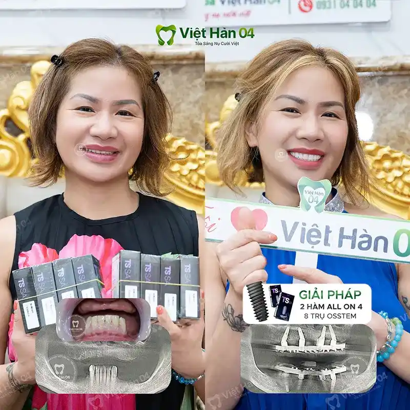 Khách hàng Laura Nguyễn - Việt Kiều Mỹ - Cấy ghép Implant toàn hàm tại Nha khoa Việt Hàn 04