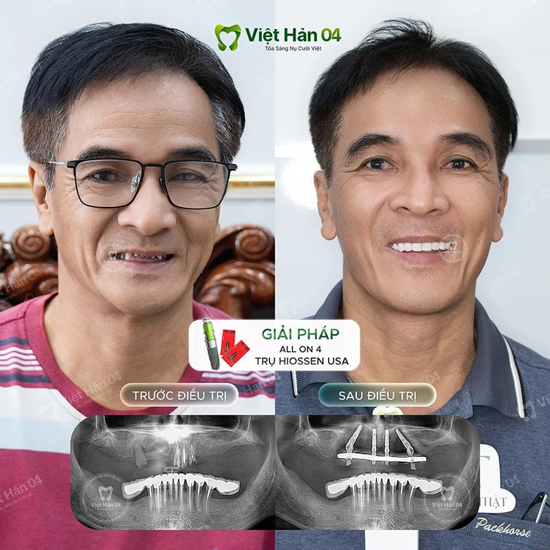 Khách hàng Đình Thọ (Vũng Tàu) cắm Implant toàn hàm all on 4 Hiossen USA - Nha Khoa Việt Hàn 04