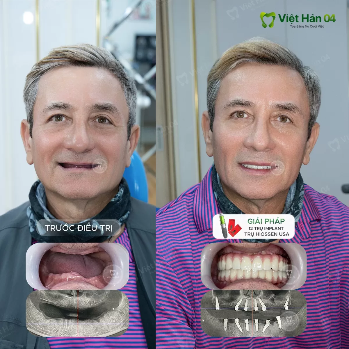Khách hàng Philips - Việt Kiều Mỹ - Cấy ghép Implant toàn hàm tại Nha khoa Việt Hàn 04
