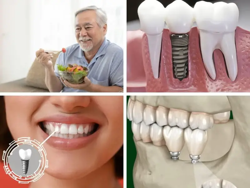 Trồng răng Implant mang lại nhiều ưu điểm 
