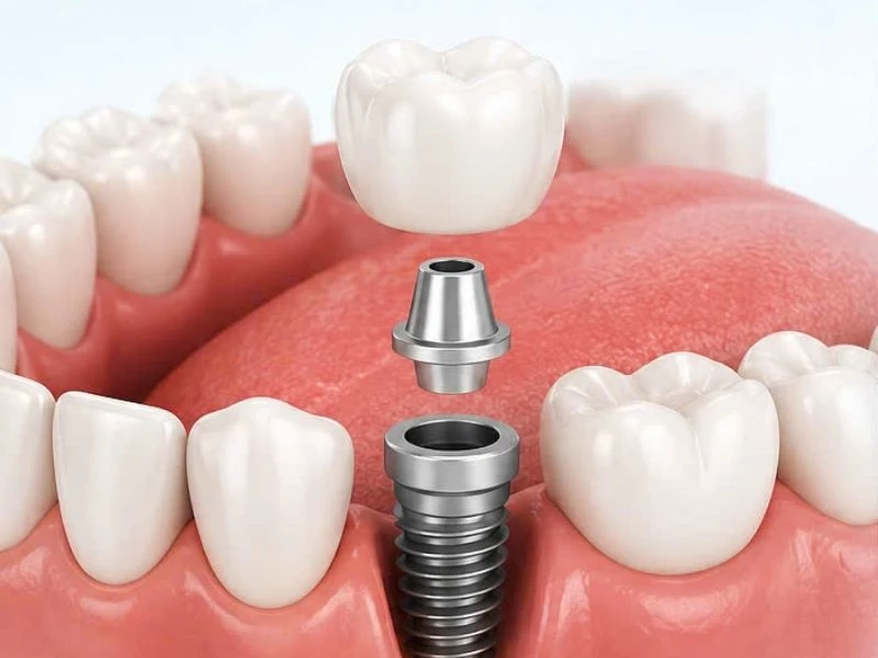 Trồng Implant trả góp giúp phục hồi răng sớm không lo chi phí phát sinh