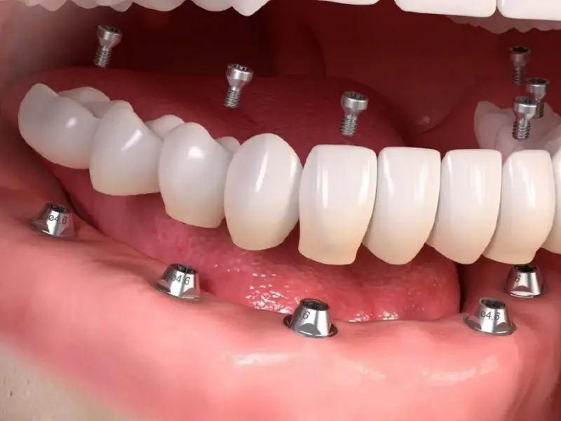 Đáp ứng điều kiện trả góp giúp điều trị Implant thuận tiện hơn 