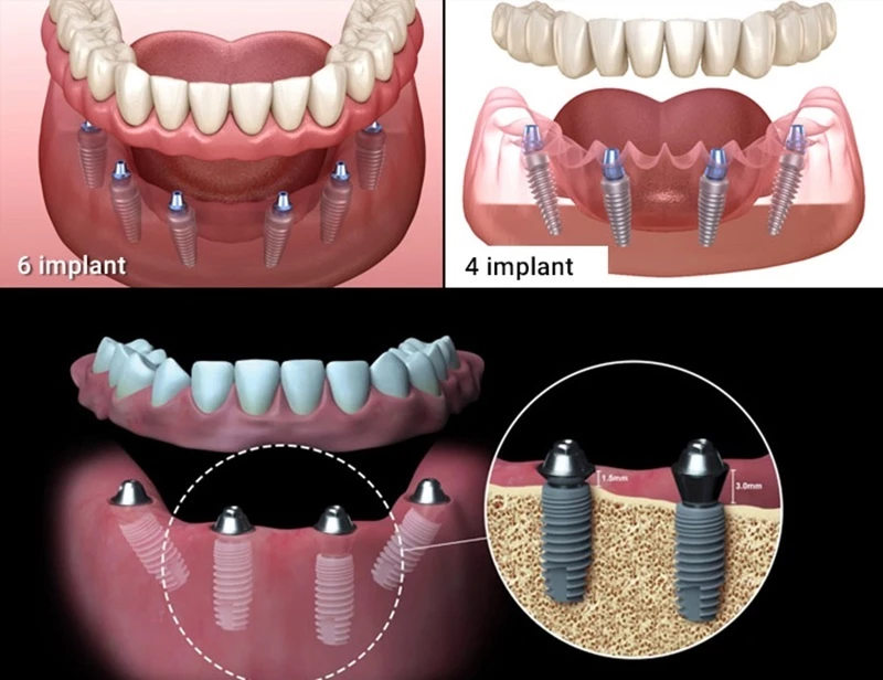 Trồng răng nguyên hàm bằng kỹ thuật cấy ghép implant mang lại hiệu quả phục hình tốt