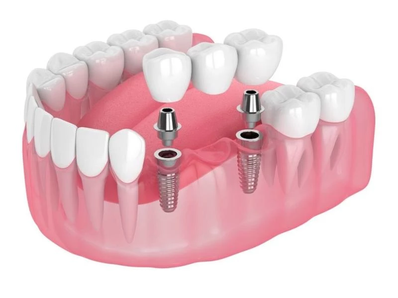 Trồng răng sứ trên implant