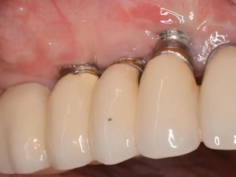 Trụ Implant bị đào thải hoặc lung lay sau cấy ghép