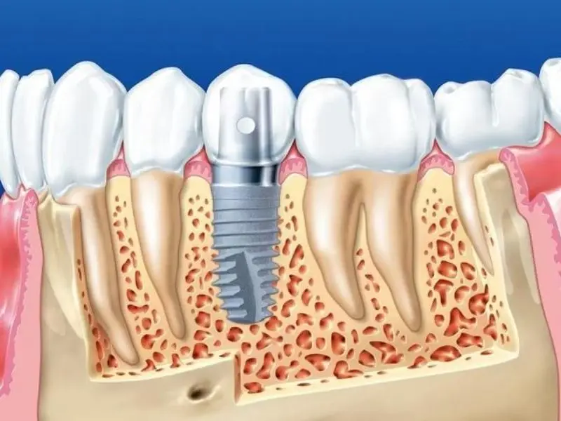 Trụ implant chất lượng tương thích với xương hàm