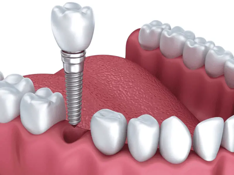 Trụ Implant chính hãng giúp tích hợp xương bền vững 