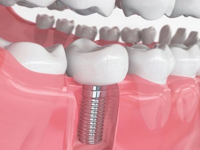 Trụ Implant Titanium được cấy ghép độc lập vào xương hàm 