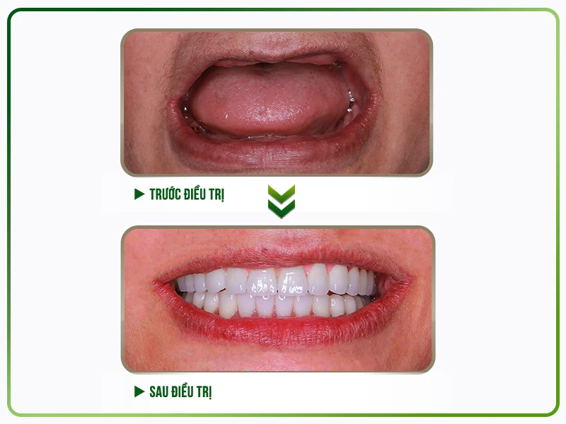 Trước và sau điều trị cấy ghép Implant tại nha khoa Việt Hàn 04