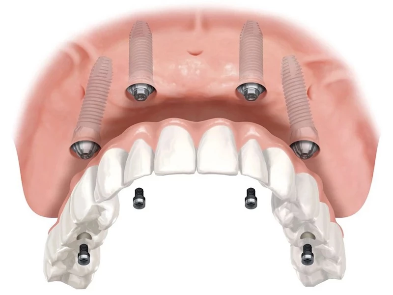 Vật liệu Implant cung cấp chính hãng