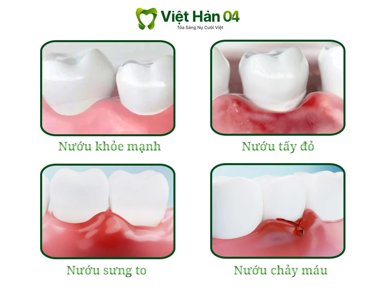 Viêm nướu là gì? Dấu hiệu nhận biết viêm nướu