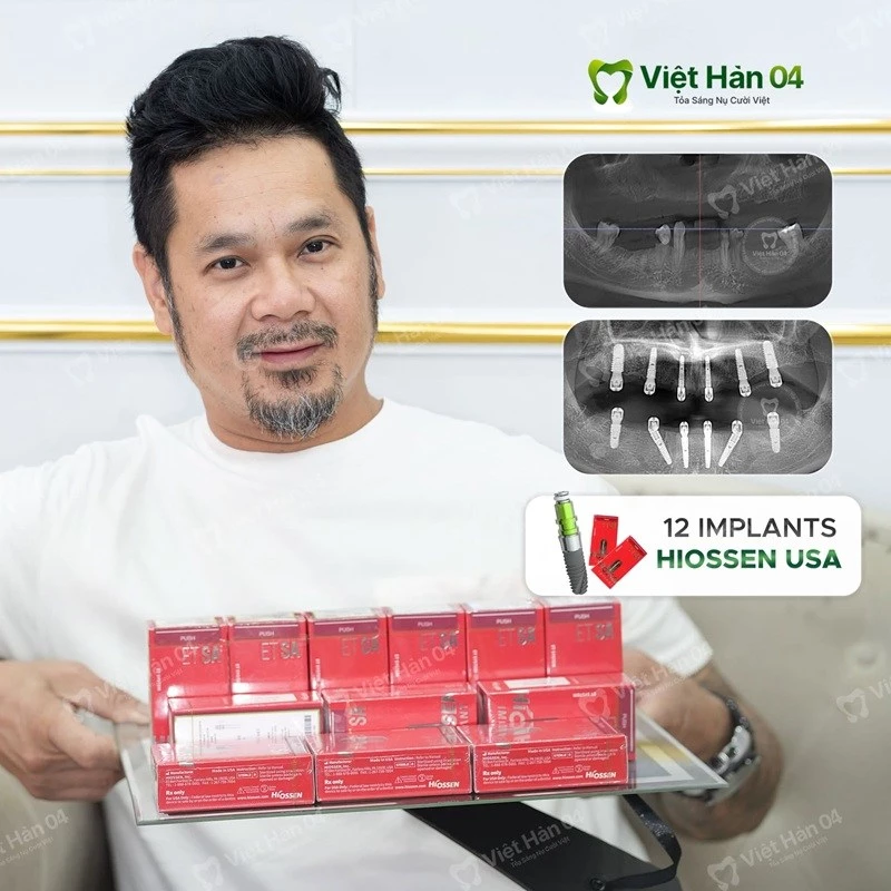 Việt kiều Mỹ - Trồng 12 trụ Implant Hiossen