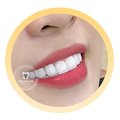 Bước 5