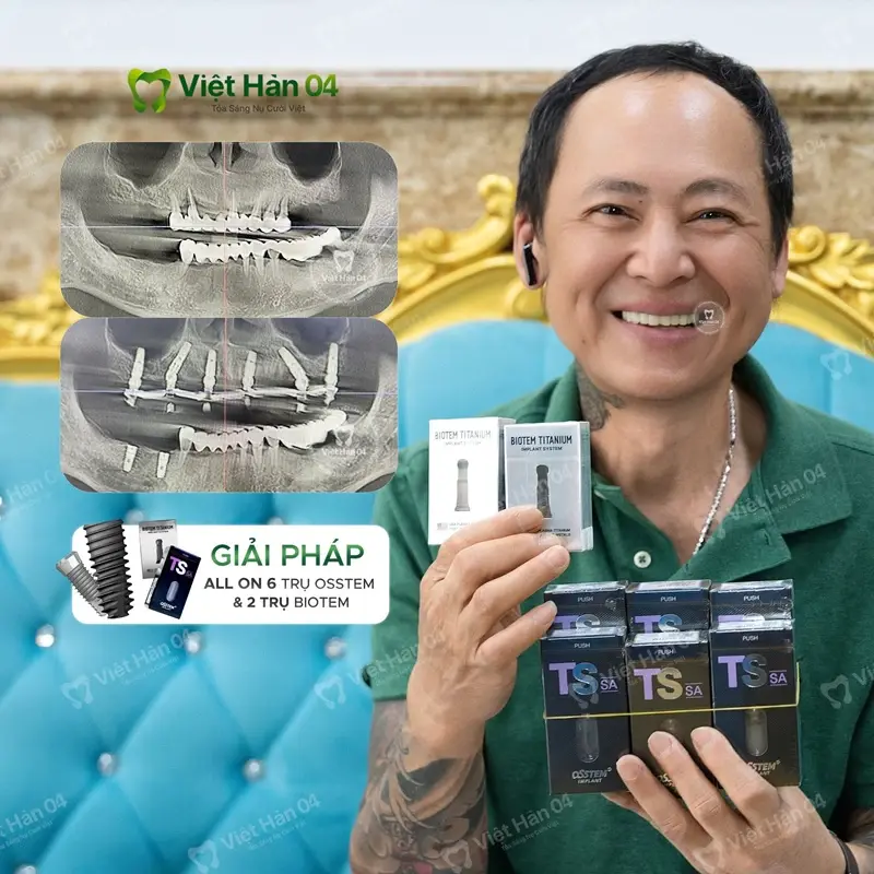 Chỉ sau 1 tuần cắm implant tại Nha khoa Việt Hàn 04