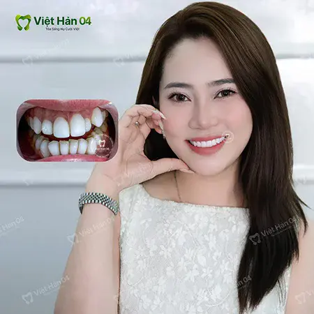 Nhan sắc thăng hạng sau khi làm 20 răng sứ Lava Plus